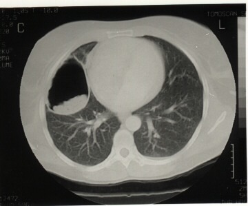 Rupture middle lung lobe