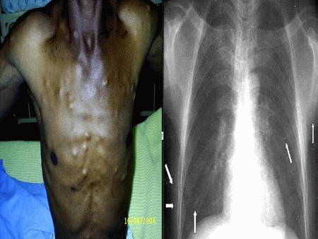 S.C. cysticercosis chest nodule