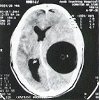 Parietal lobe hydatid cyst