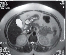 Renal hydatid cyst