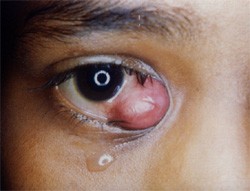 Subconjunctival cysticercosis