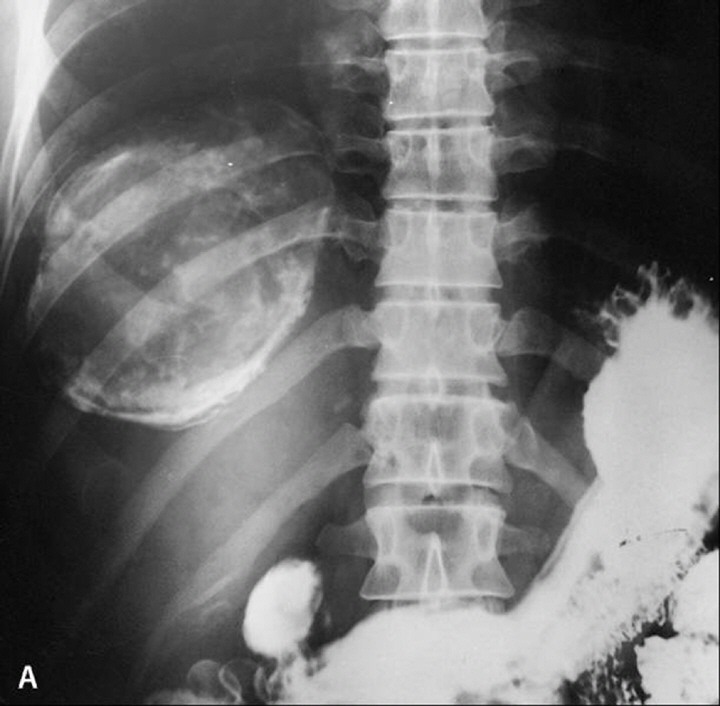 Calcified cyst