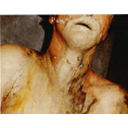 Show Suicidal ingestion of phenol. Image